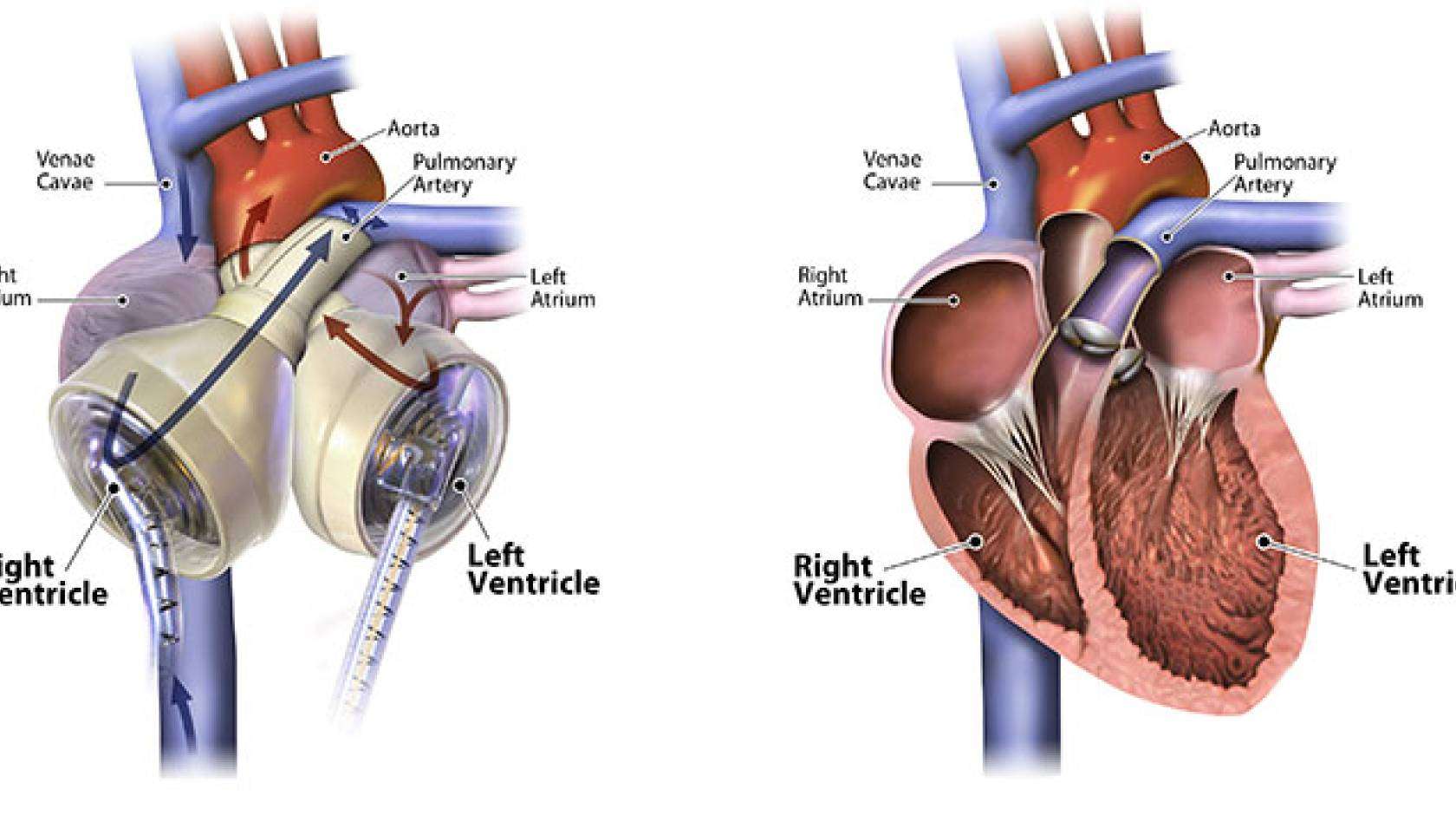 Artificial Heart Transplants