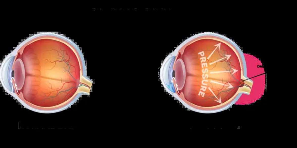 Can Glaucoma Treatment OKC Stop the Progression of Glaucoma