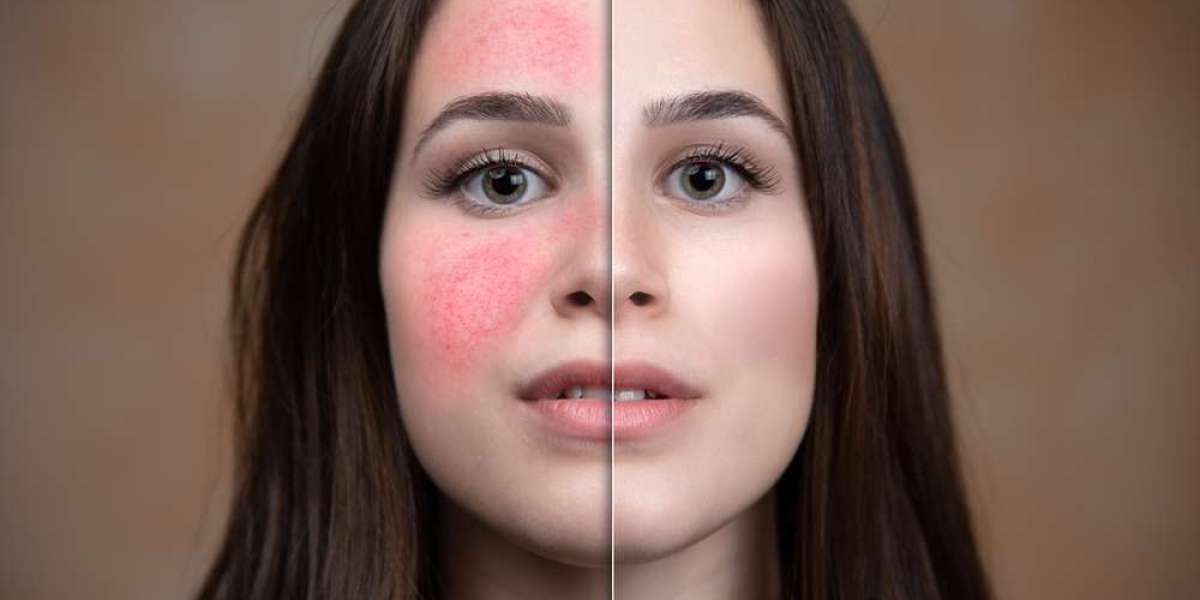 "Redness Redemption: Facial Capillaries Treatment Approaches"