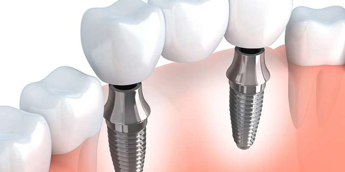 The Next Frontier: Zirconium Implants in Modern Dentistry