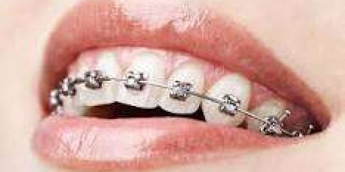 Dental Braces for Correcting Bite Issues: Dubai Experts' Insights