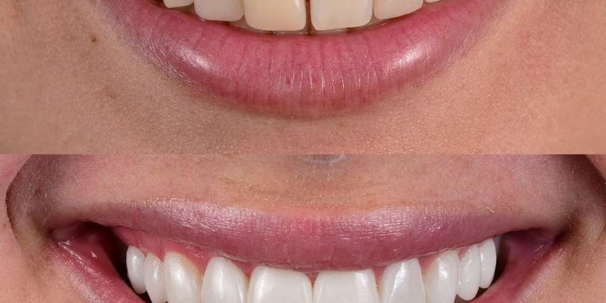 Composite Veneers: A Symphony of Form and Function