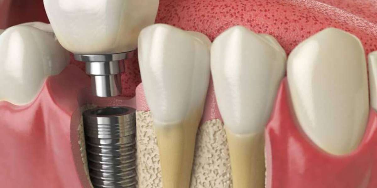 Aesthetic Implantology: Sculpting Smiles with Precision