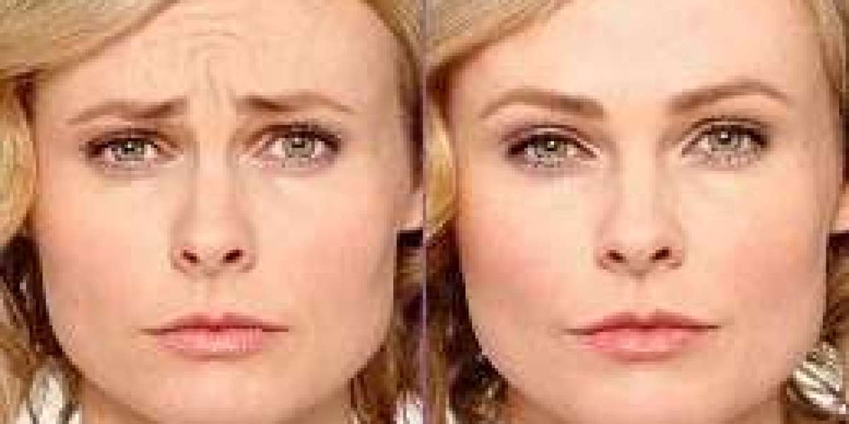 Facial Renewal: Botox and the Science of Beauty