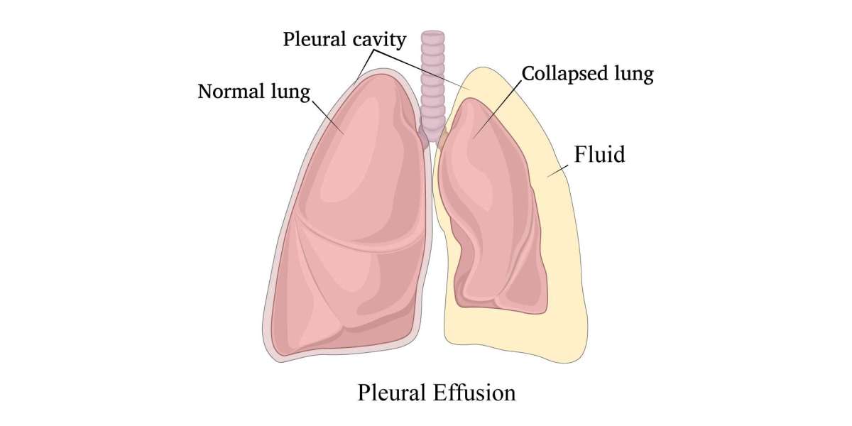 pleural effusion treatment cost in india