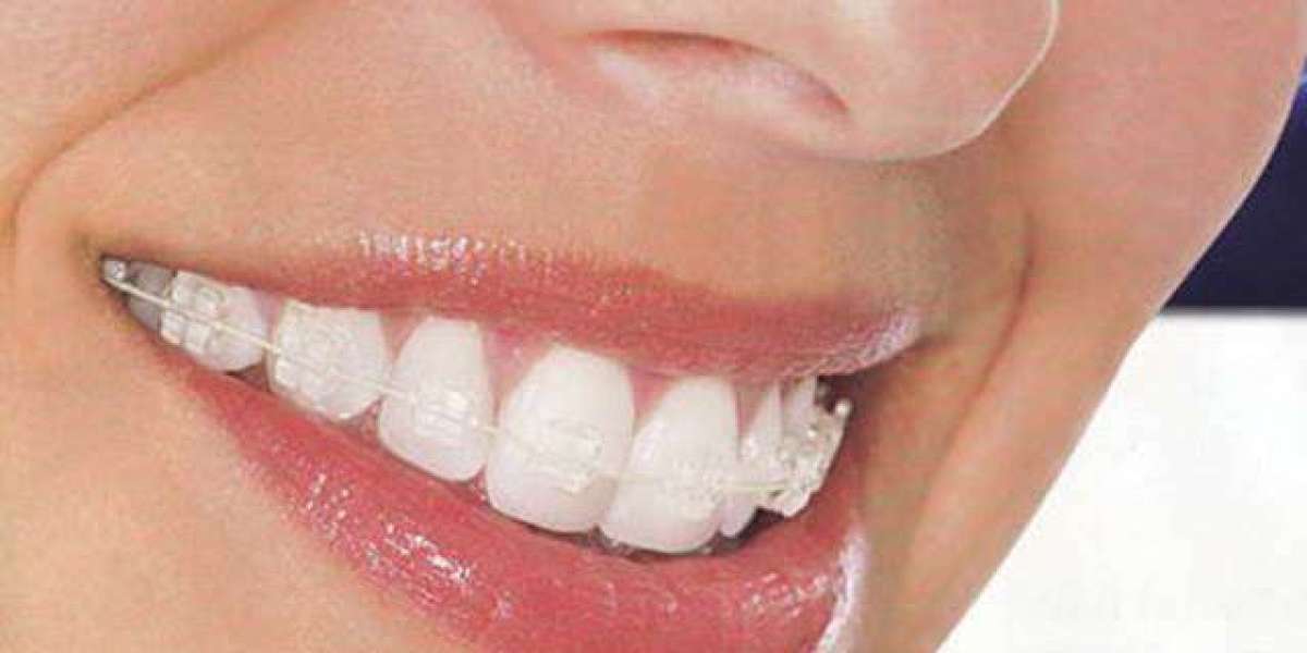 Whispers of Change: The Subtle Impact of Ceramic Braces