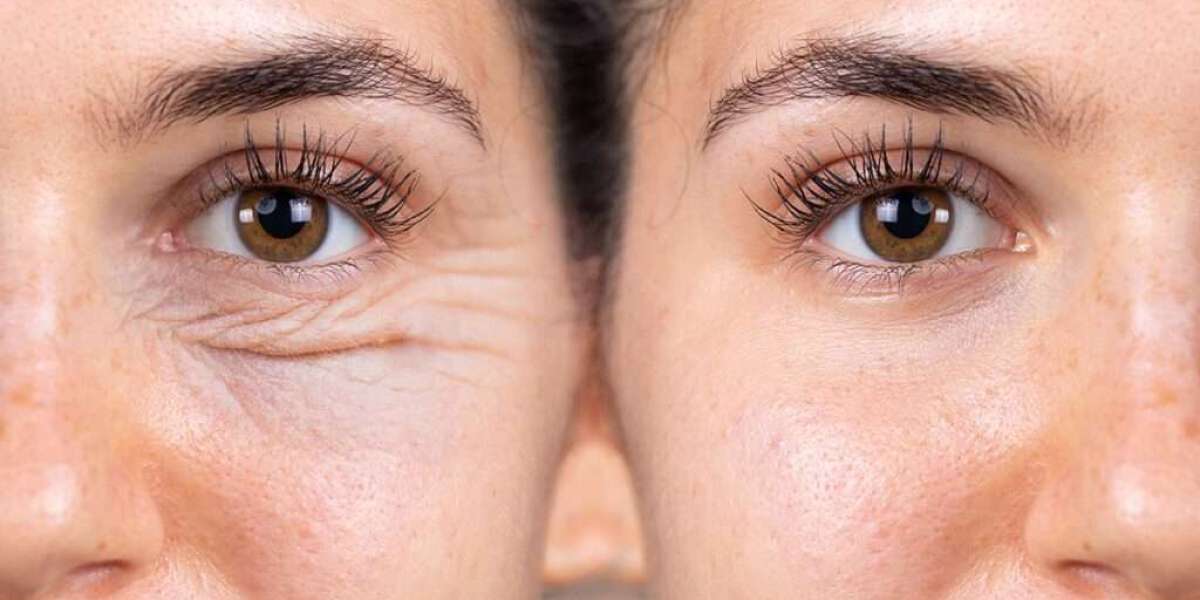 Eyes Wide Open: The Dubai Guide to Stunning Eyelid Transformations