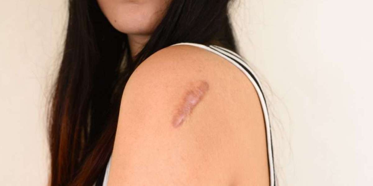 Keloid Removal Made Easy: Dubai's Top Clinics and Techniques