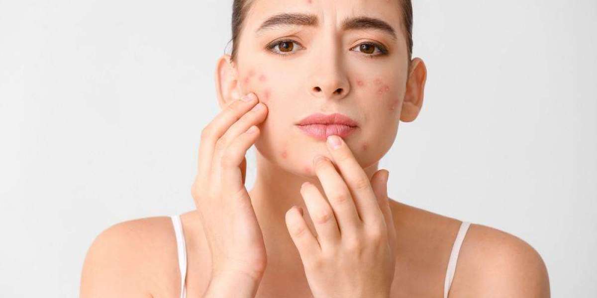 Transform Your Skin with Acne Treatment in Dubai