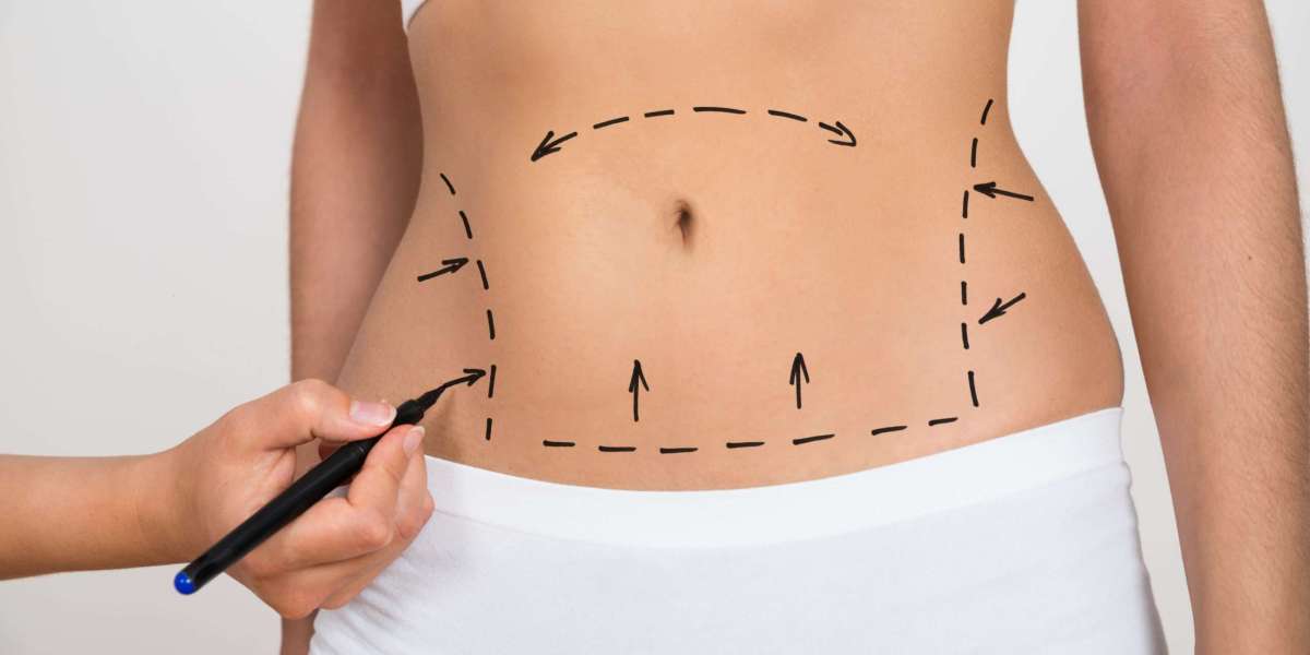 Sculpting Dreams: The Ultimate Guide to a Stunning Tummy Tuck in Dubai!
