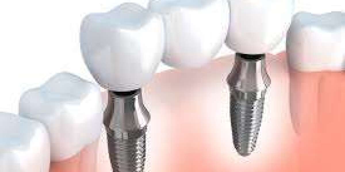Precision and Perfection: Dental Implant Techniques Redefined in Dubai