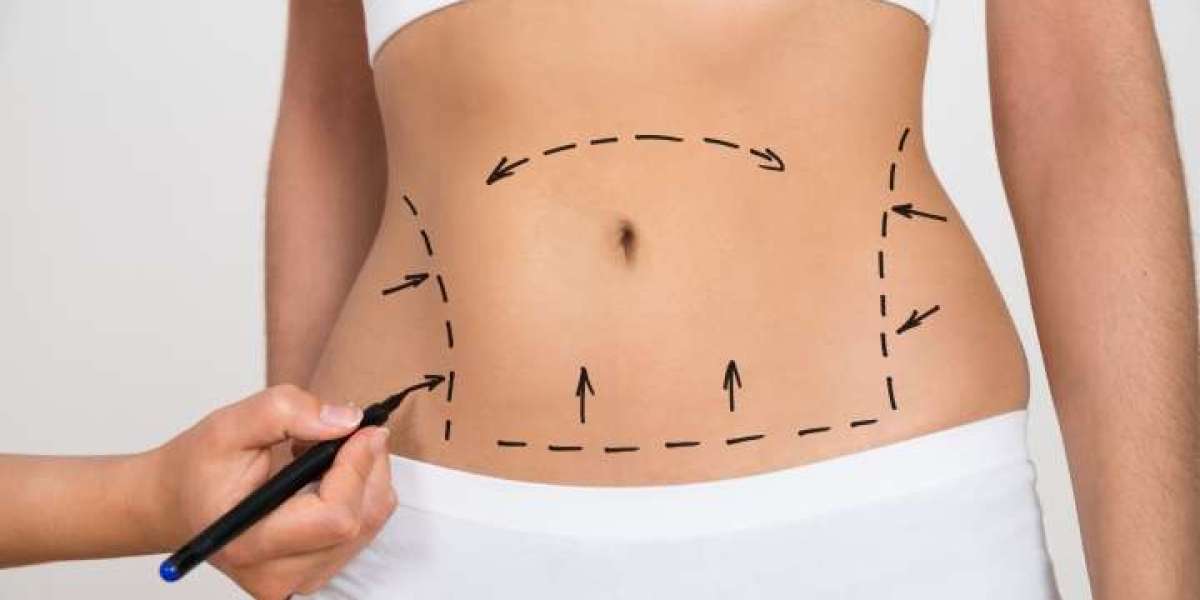 Sculpting Confidence: The Art and Science of Tummy Tuck