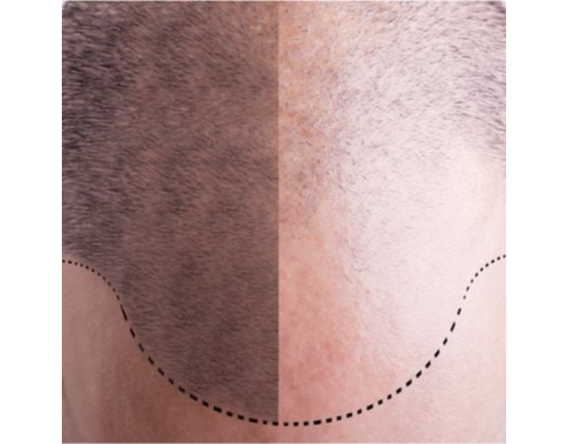 Rediscovering Confidence: The Art and Science of Hair Transplants | by PNW Plastic Surgery | Jan, 2024 | Medium