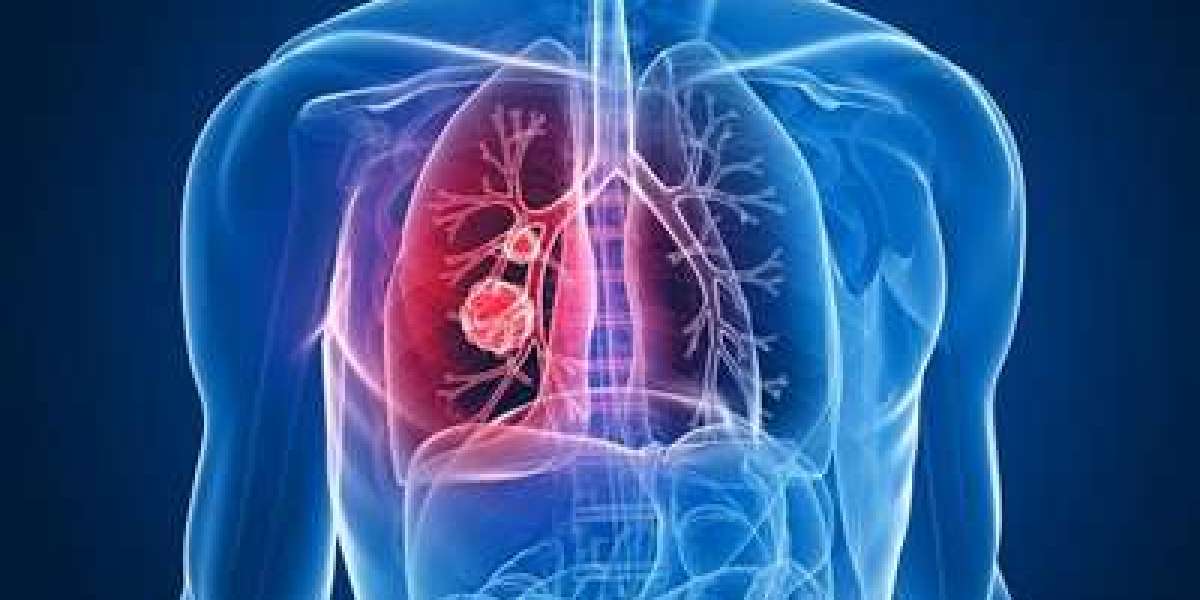 Lung Biopsy Systems Market to Grow at a CAGR of 9.80% between 2023 and 2030