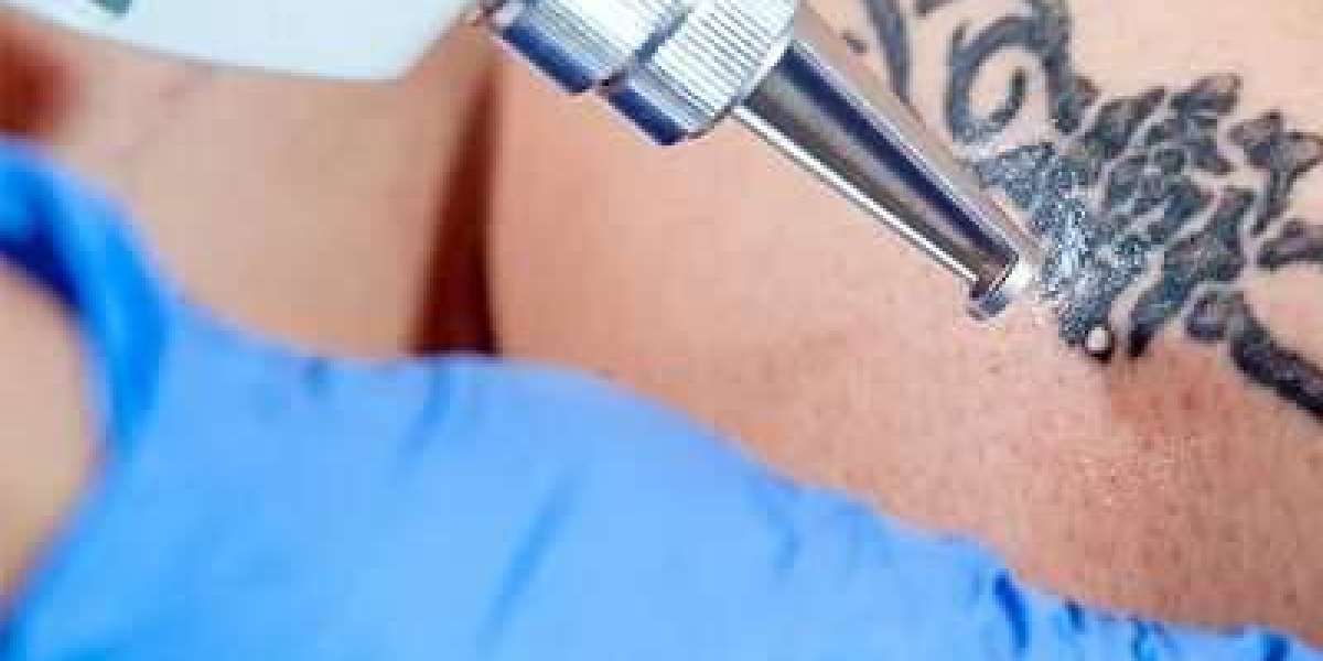 Laser Tattoo Removal and Pregnancy: What You Need to Know