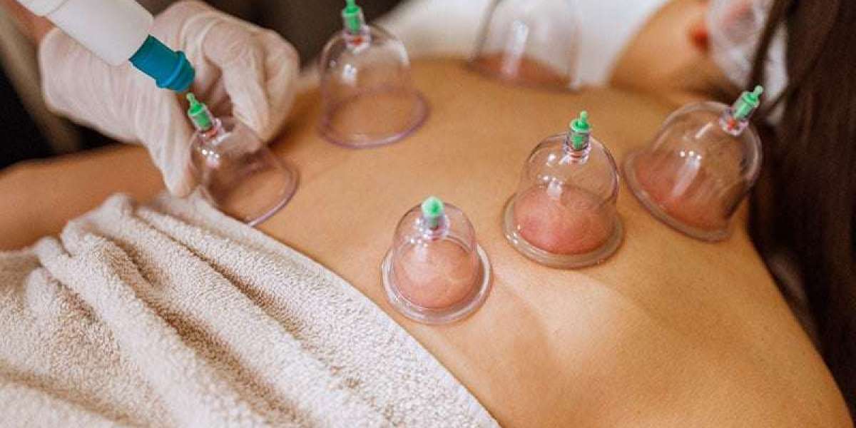 Cupping Culture: Hijama Therapy's Resilience in Dubai's Wellness Landscape