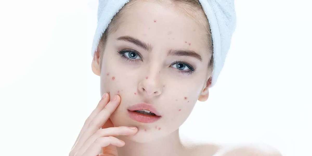 Acne Treatment Breakthroughs: Dubai's Latest Advances