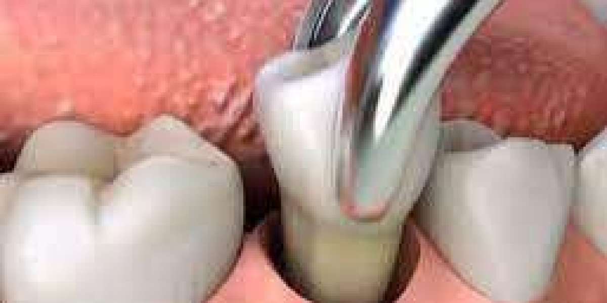 خلع الأسنان في حالات الطوارئ: استجابة دبي السريعة