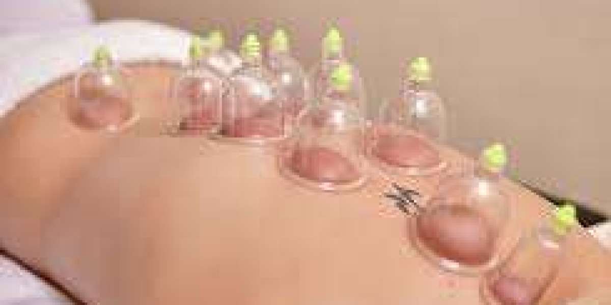 "Traditional Healing, Modern City: Hijama Therapy Unveiled in Dubai"