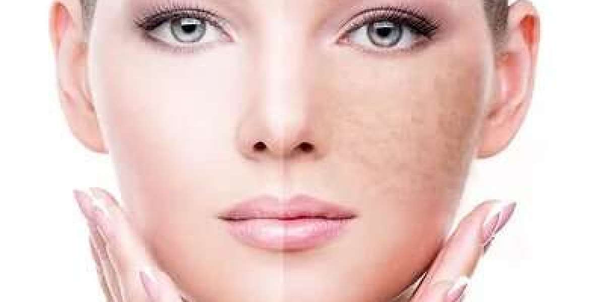 Spot-Free Confidence: Empowering Pigmentation Treatment Solutions