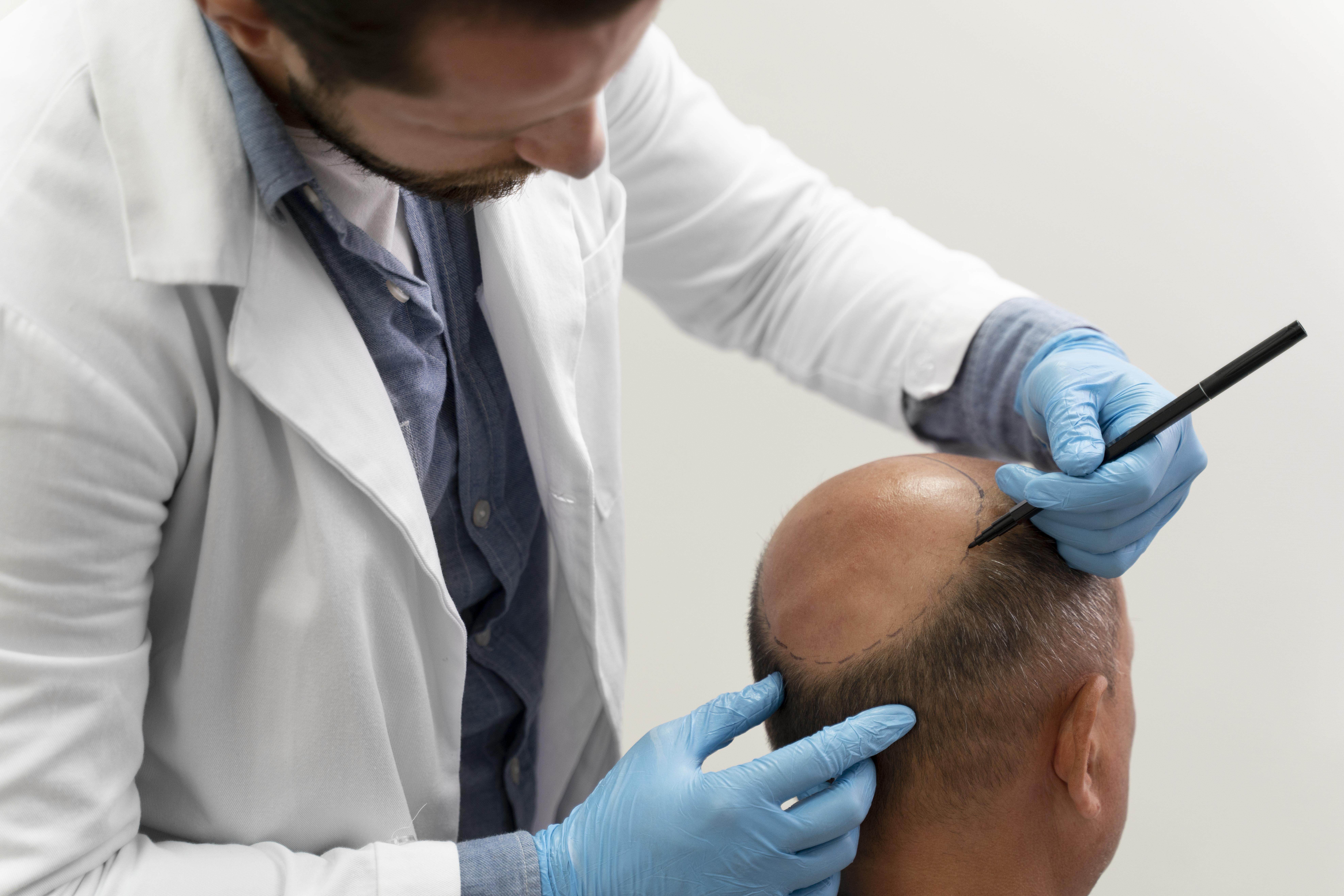 Male Pattern Baldness: Stages, Treatment, and Solutions with Neoaesthetica - Neoasthetica