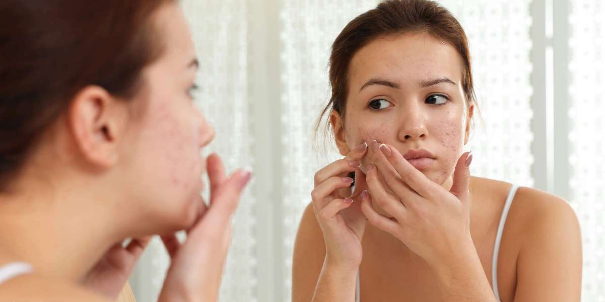 Flawless Skin Awaits: Acne Treatment in Dubai