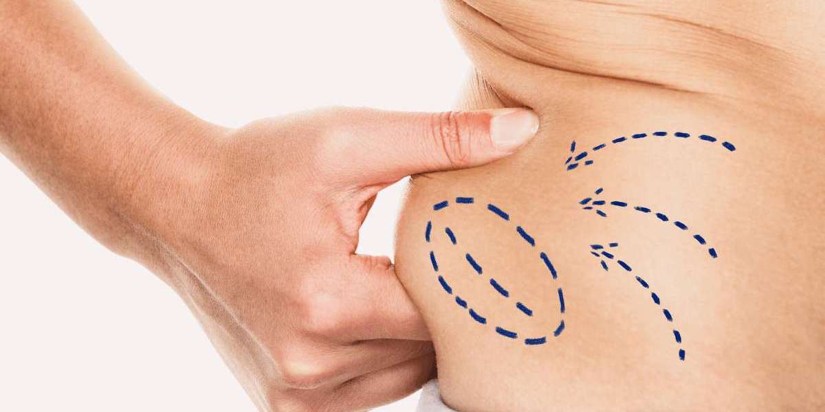 Unlock Your Dream Body: Liposuction in Dubai Demystified!