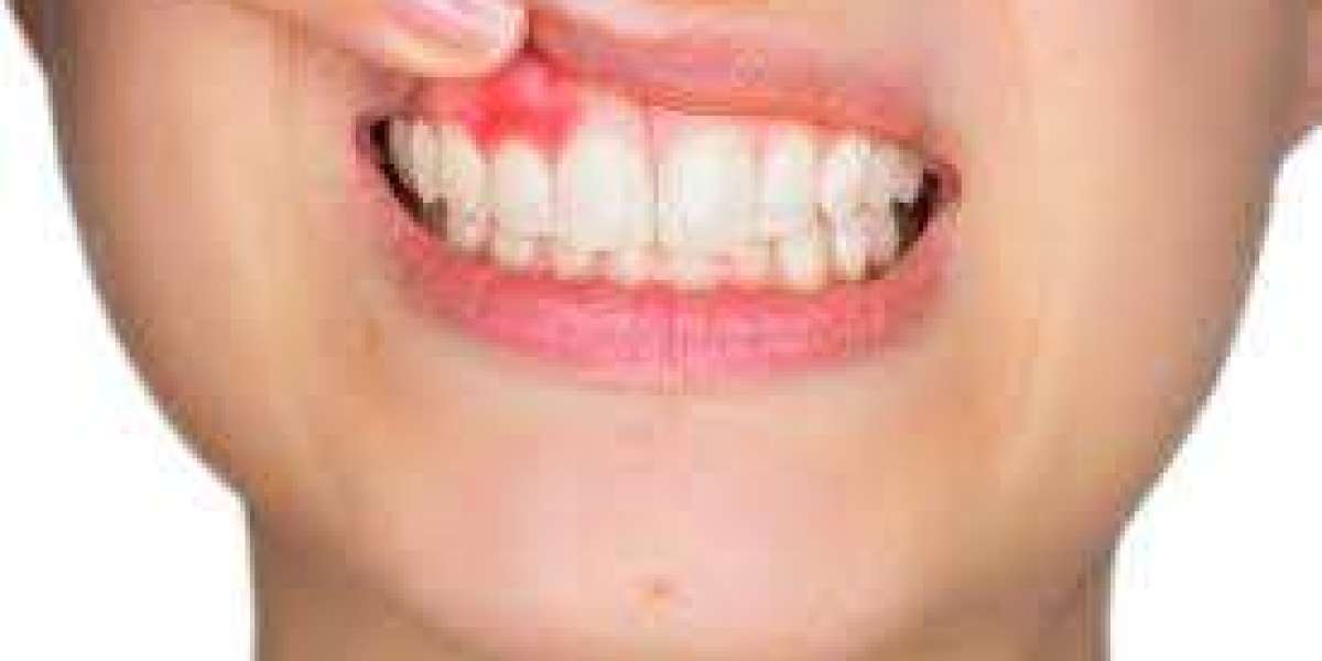 Comprehensive Guide to Gum Disease Treatment in Fort Lauderdale
