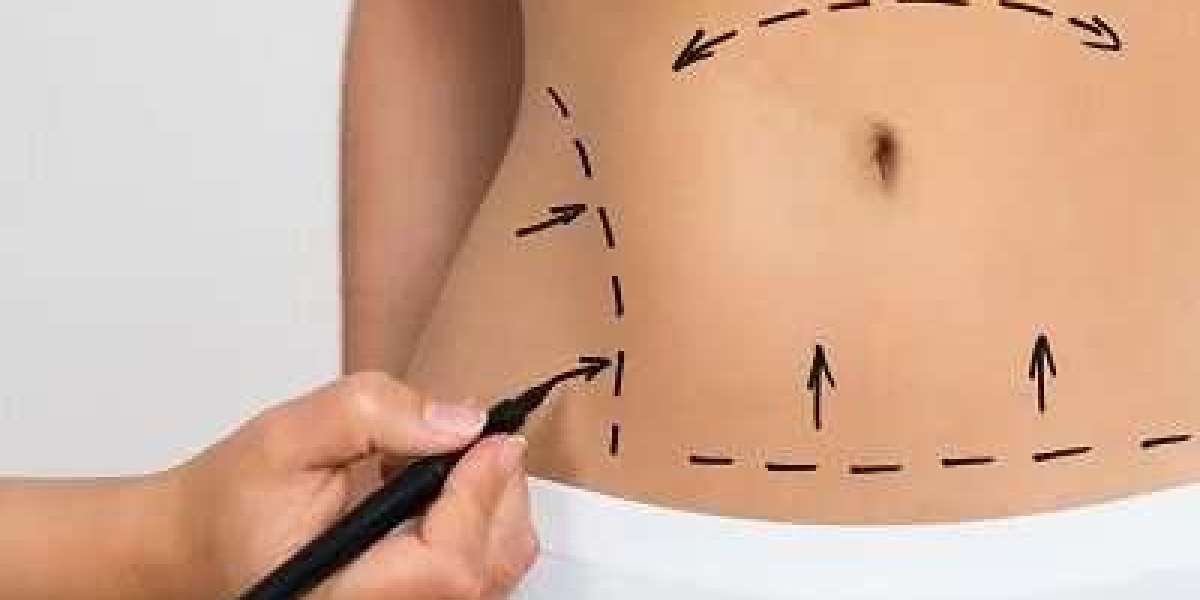 The A to Z of Abdominoplasty: A Comprehensive Glossary