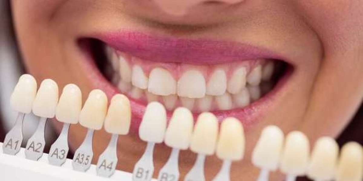 Brighten Your Smile: The Ultimate Guide to Teeth Whitening in Essex