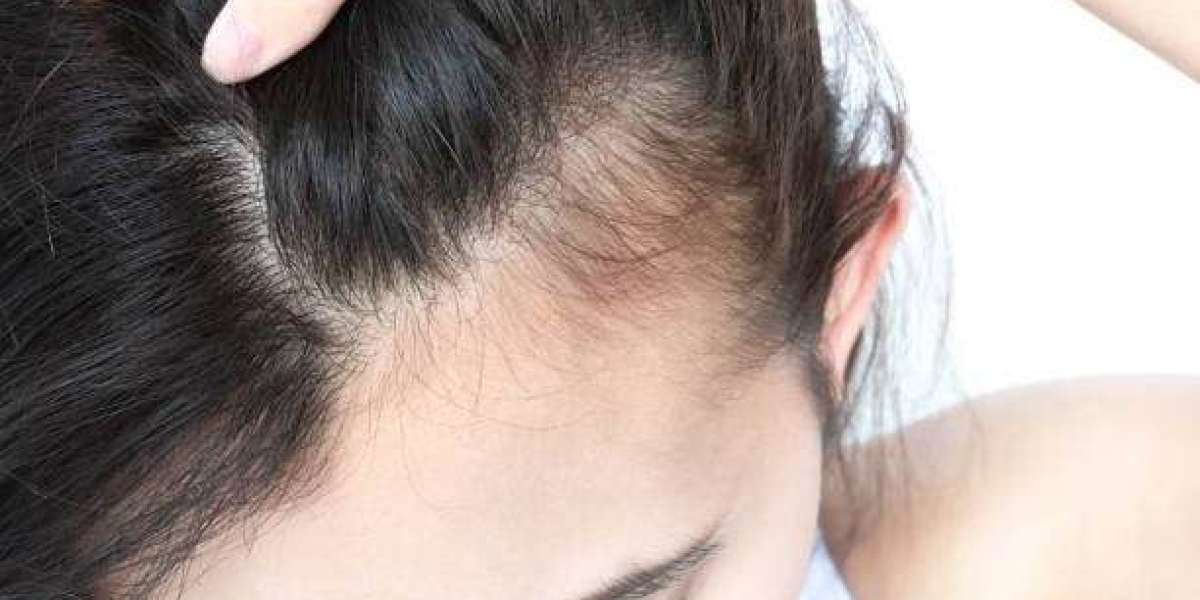 Dubai's Elite Choice for Natural Hair Restoration with Stem Cells