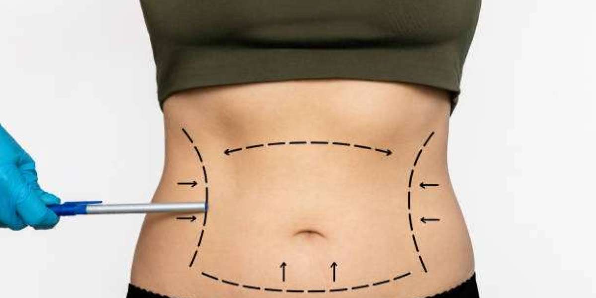 Liposuction: Dubai's Post-Weight Loss Transformation