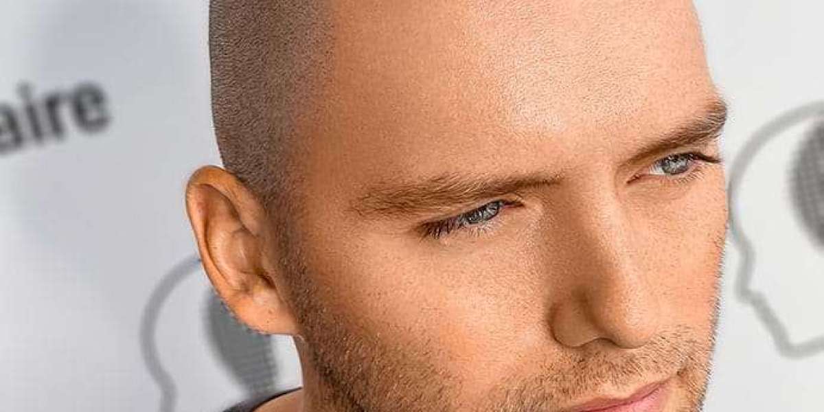 Crowning Glory: The Ultimate Scalp Micropigmentation Experience in Dubai