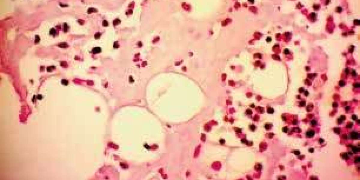 AL Amyloidosis Market Trends: Epidemiology, Size, Share, Analysis and Forecast till (2023-2033)