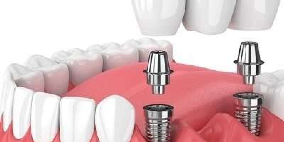 Insurance Coverage for Dental Implants: What You Need to Know