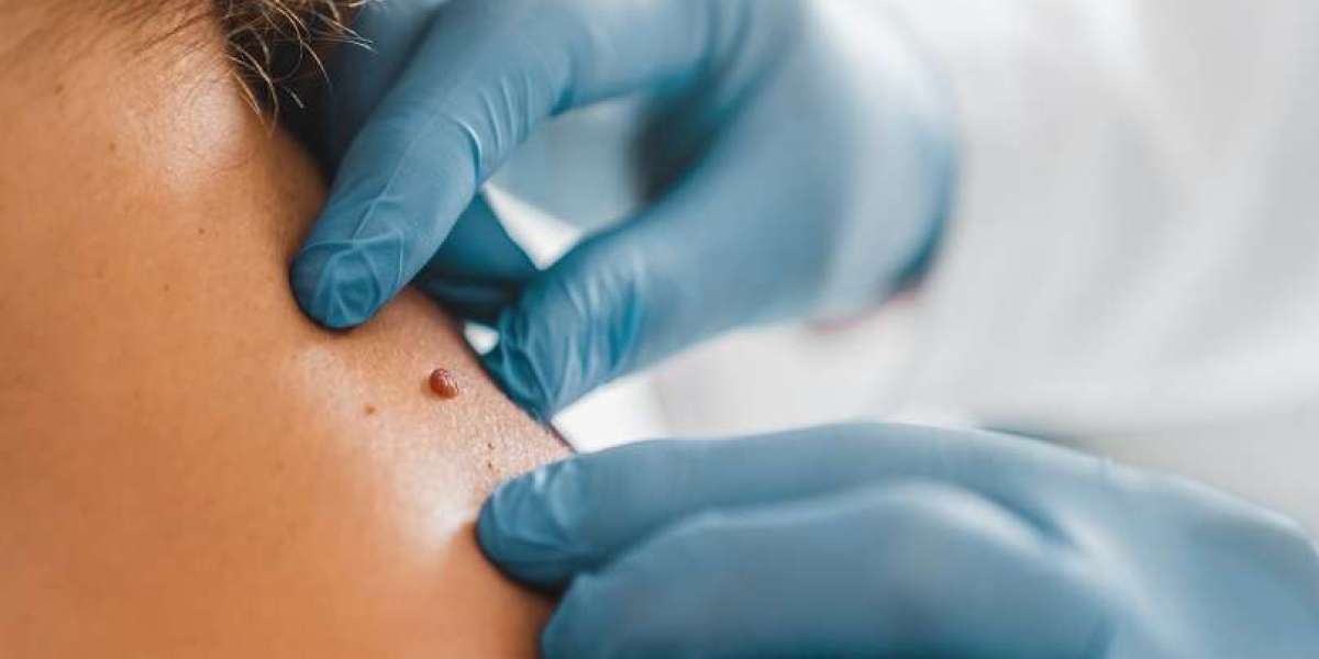 How to Get Rid of Skin Tags Without Hurting Yourself
