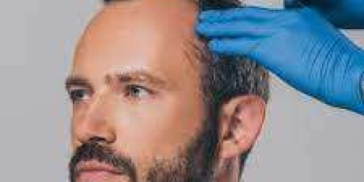 Dubai's Tress Triumph: Combatting Hair Loss