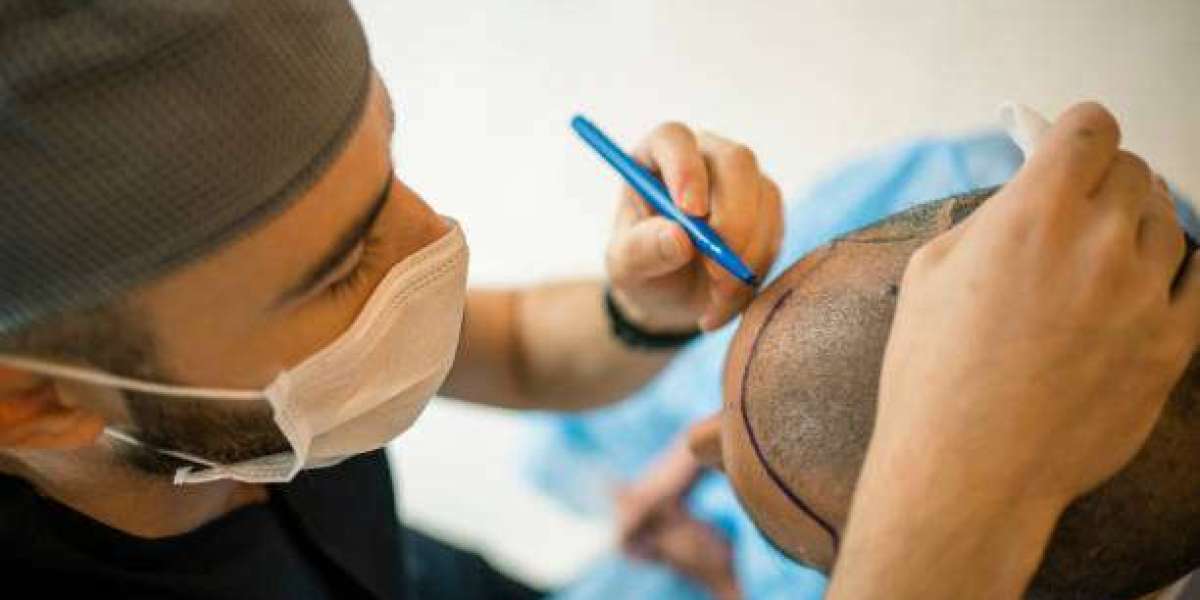 Innovations in Hair Restoration: Dubai's Pioneering Techniques