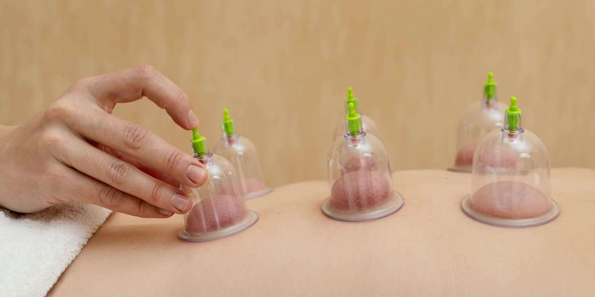 Balancing Act: Cupping Therapy's Appeal in Dubai