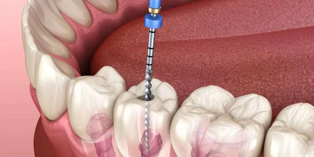 Root Canal vs. Tooth Extraction: Making the Right Dental Decision