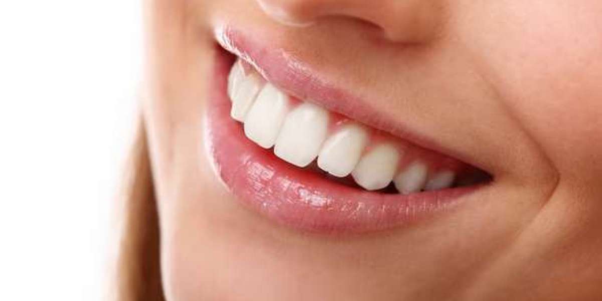 Beyond Bright: Achieving Dazzling Smiles with Laguna Niguel Teeth Whitening