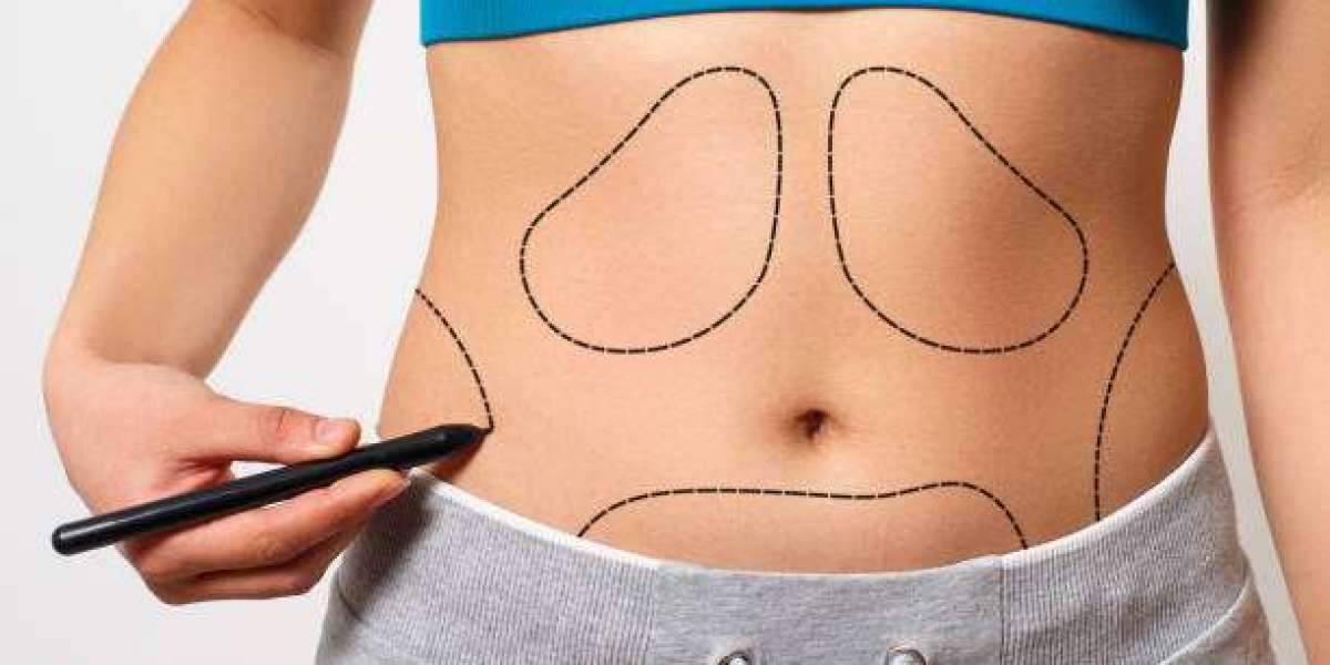 Transform Your Body: The Ultimate Guide to Tummy Tuck in Dubai