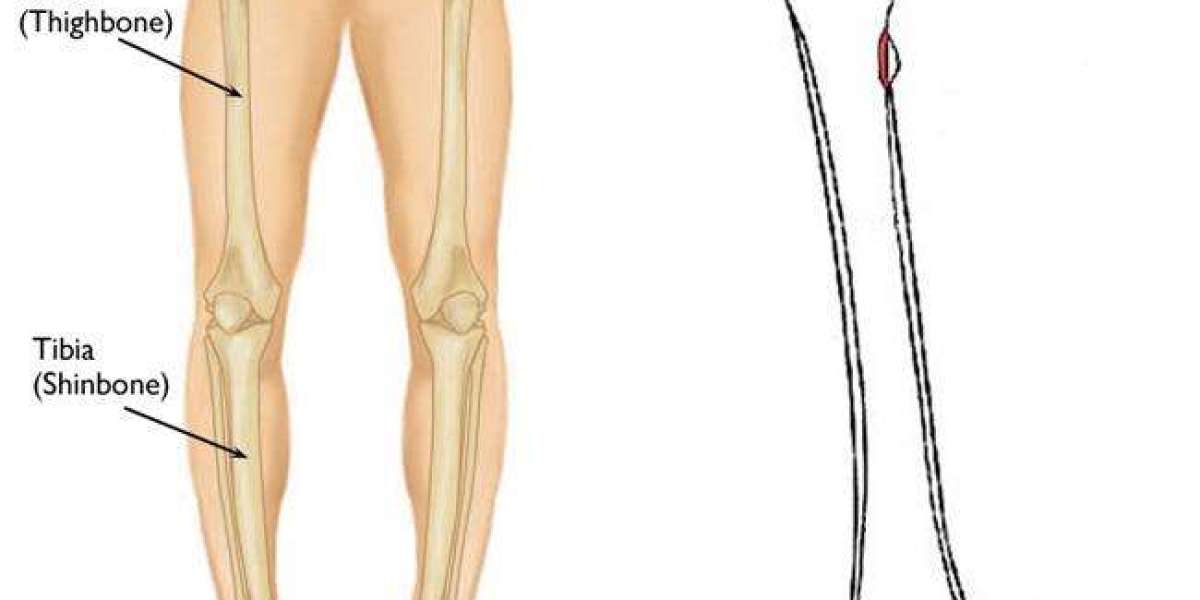 South Korea Limb/Leg Lengthening Surgery Market Size, Share, Forecast 2023 - 2033