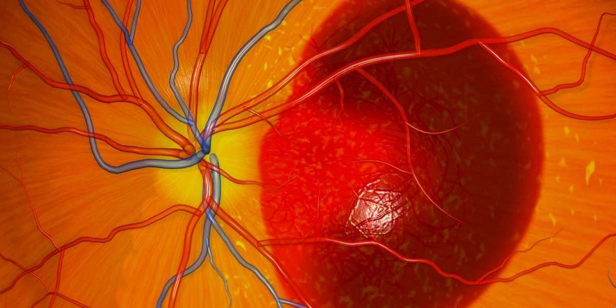 Age Related Macular Degeneration Market Projected to Show Strong Growth