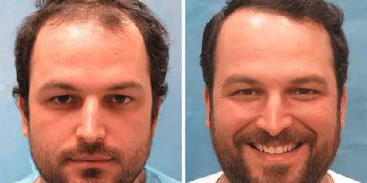 Dubai's Grooming Game-Changer: Beard Hair Transplantation Unveiled