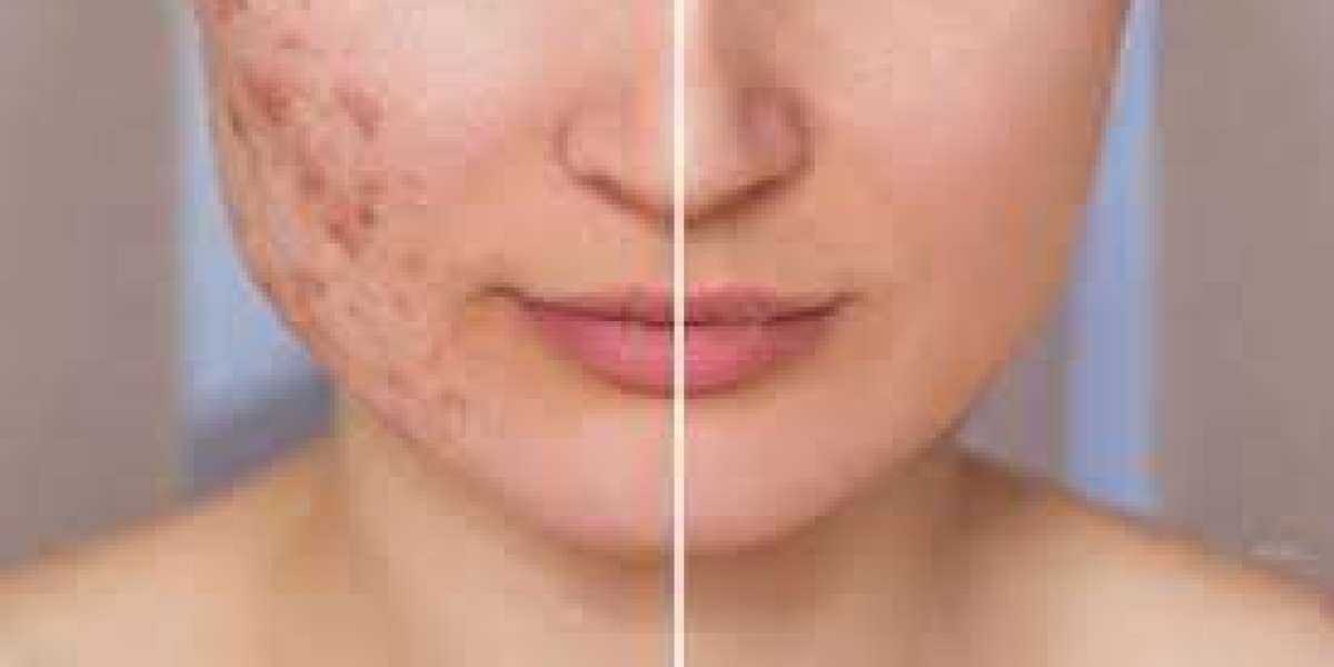Unveiling the Journey to Flawless Skin: A Comprehensive Guide to Acne Scar Treatment