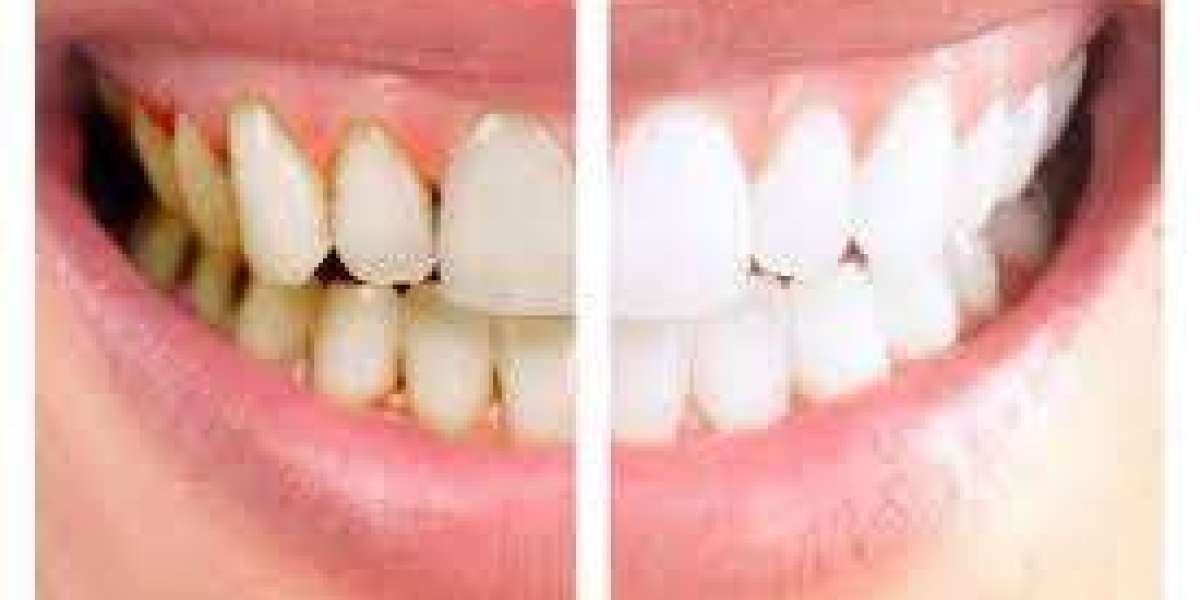 "Debunking Myths Surrounding Teeth Polishing in Dubai