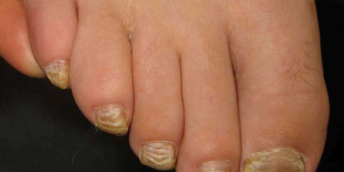Nail Disorder Relief: Trusted Treatments in Dubai