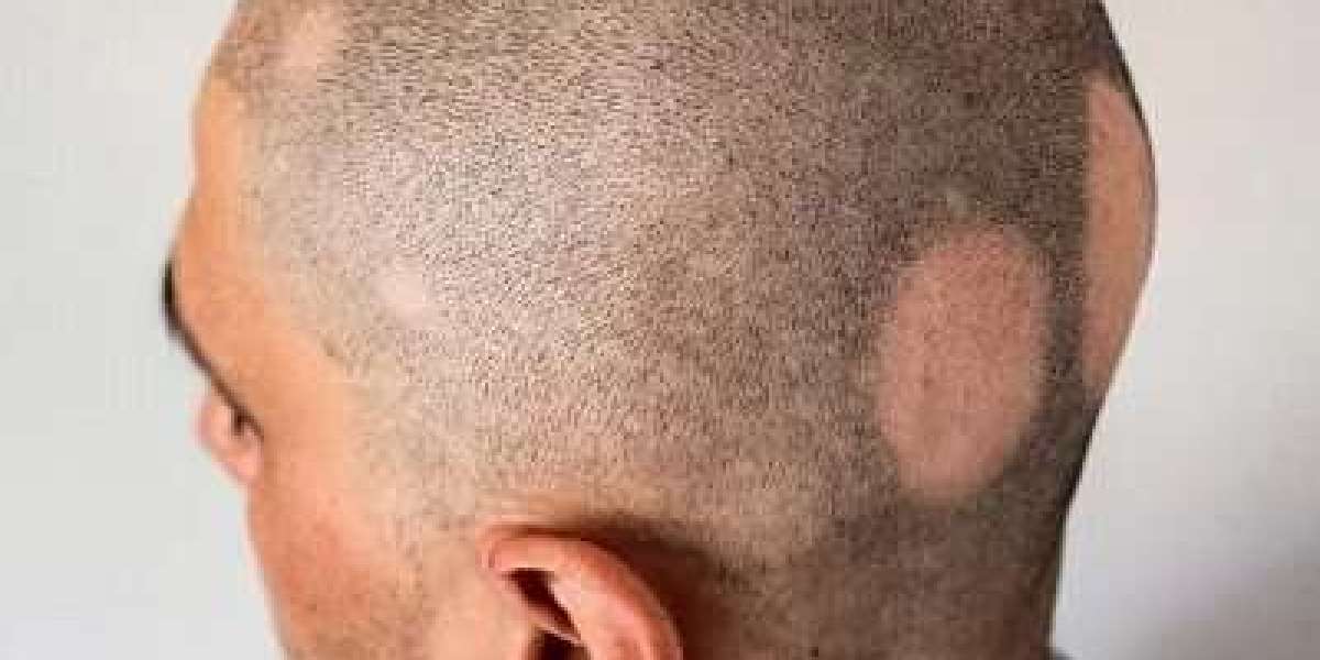 Over-the-Counter Solutions: Can They Help Alopecia Areata?