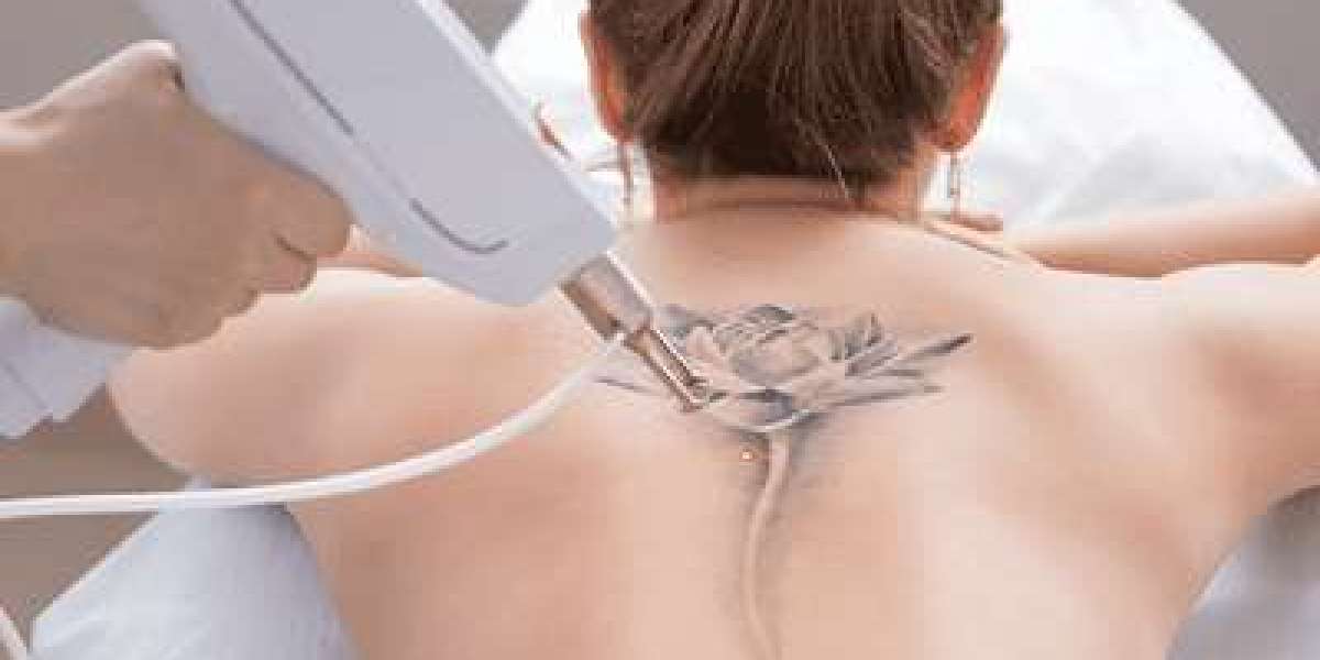 Benefits and Risks of Laser Tattoo Removal: What You Need to Know